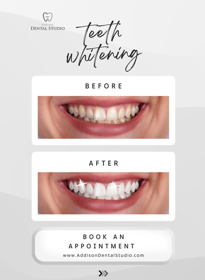 Addison Dental Studio | Crowns  amp  Caps, Night Guards and Periodontal Treatment