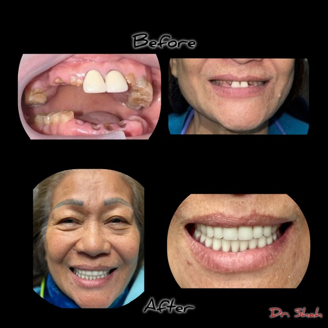 Addison Dental Studio | Dentures, Night Guards and Sleep Apnea