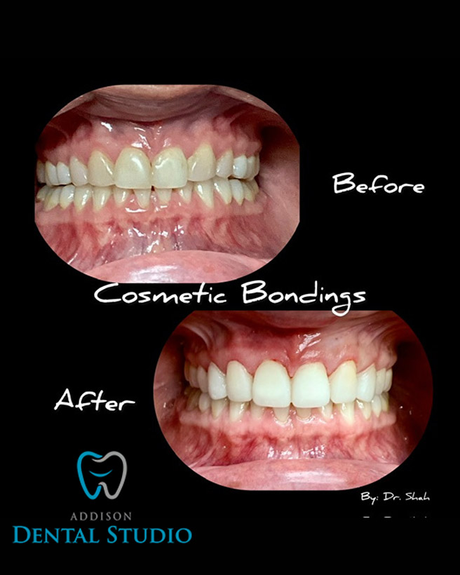 Addison Dental Studio | Sedation Dentistry, Fluoride Treatment and Invisalign reg 