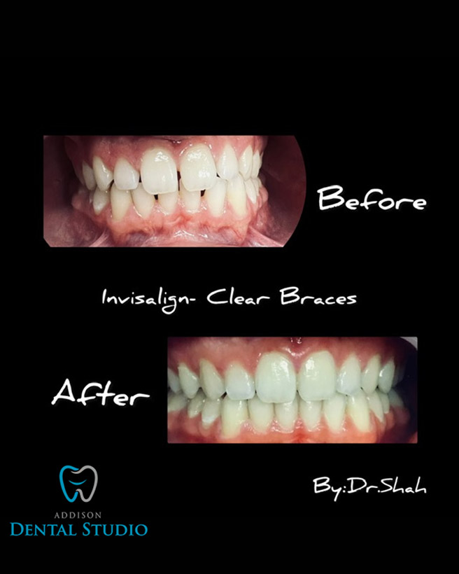 Addison Dental Studio | Root Canals, Sports Mouthguards and Implant Restorations