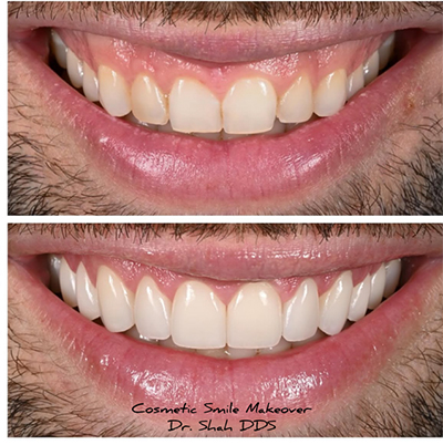 Addison Dental Studio | Sleep Apnea, Veneers and Dental Bridges