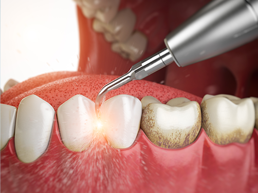 Addison Dental Studio | Dentures, Extractions and Intraoral Camera