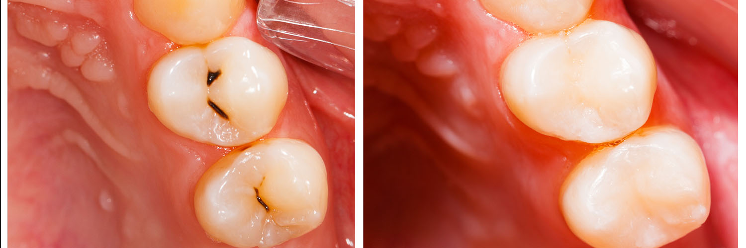Addison Dental Studio | Implant Restorations, Preventative Program and Dental Sealants